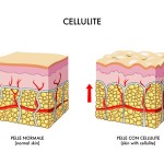 cellulite